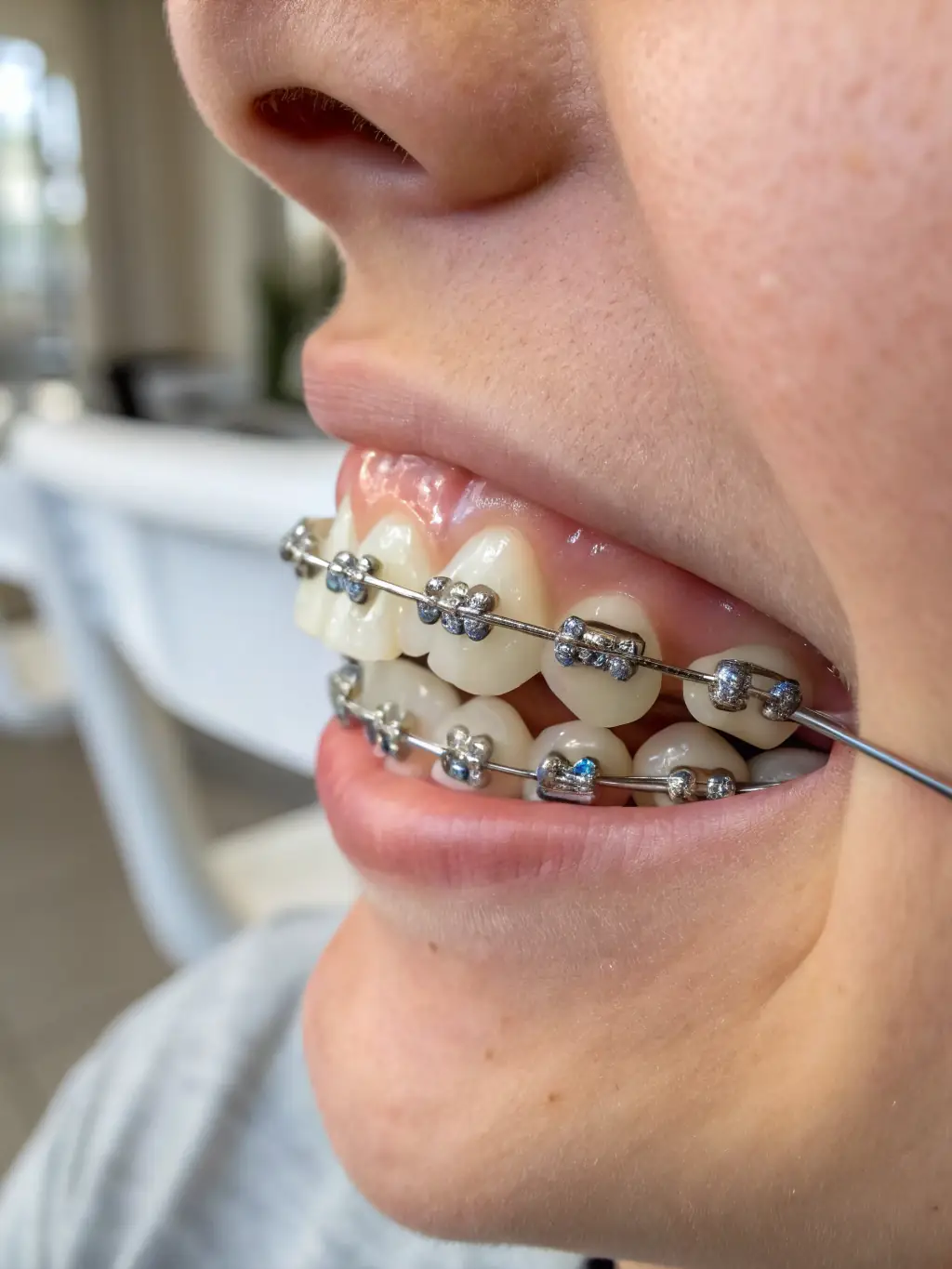 A view of lingual braces placed behind the teeth, with a focus on their hidden placement. The image should demonstrate their invisibility from the front.