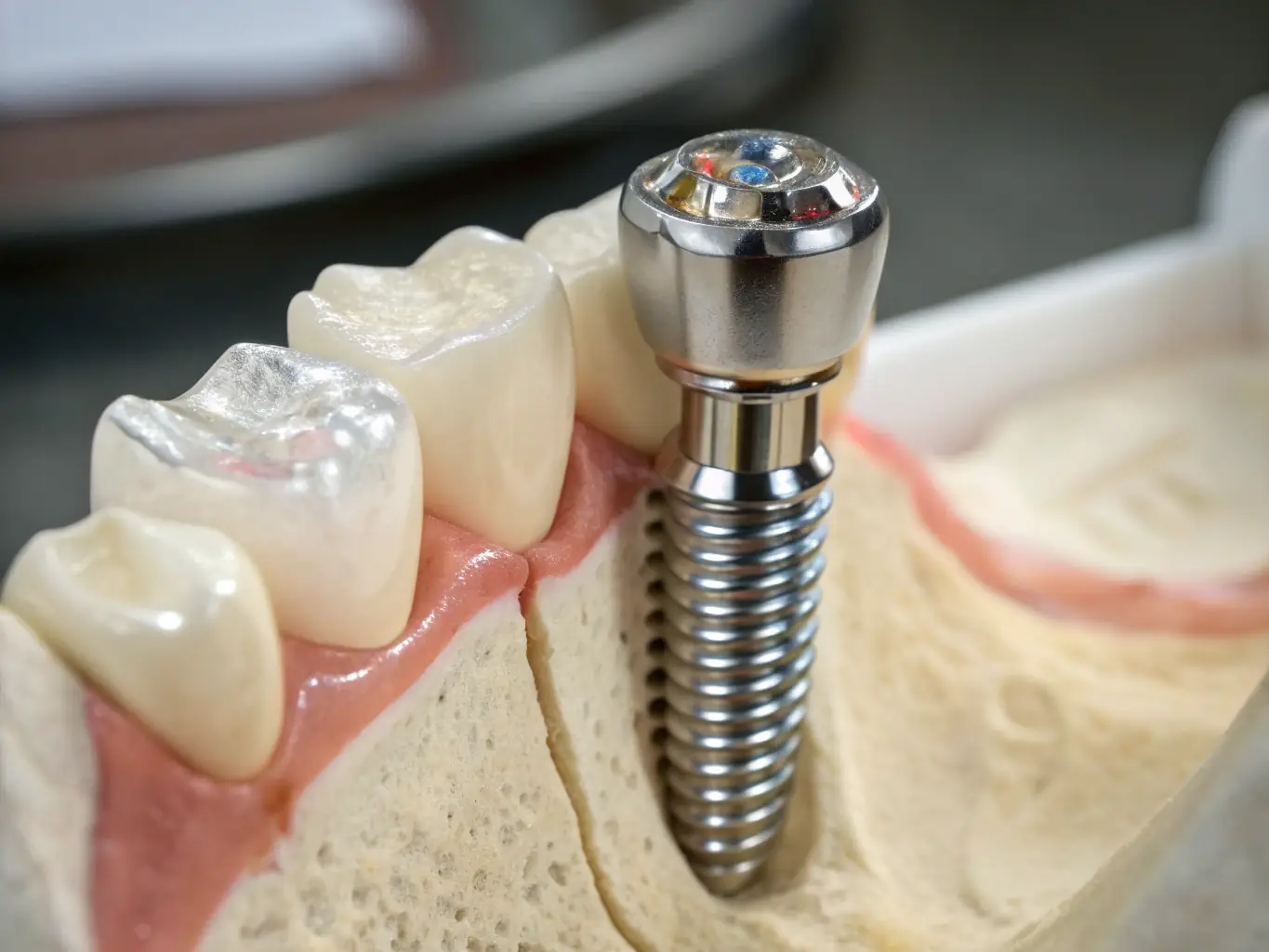 A close-up of a dental implant seamlessly integrated into a patient's jaw, showcasing its natural appearance and stability.
